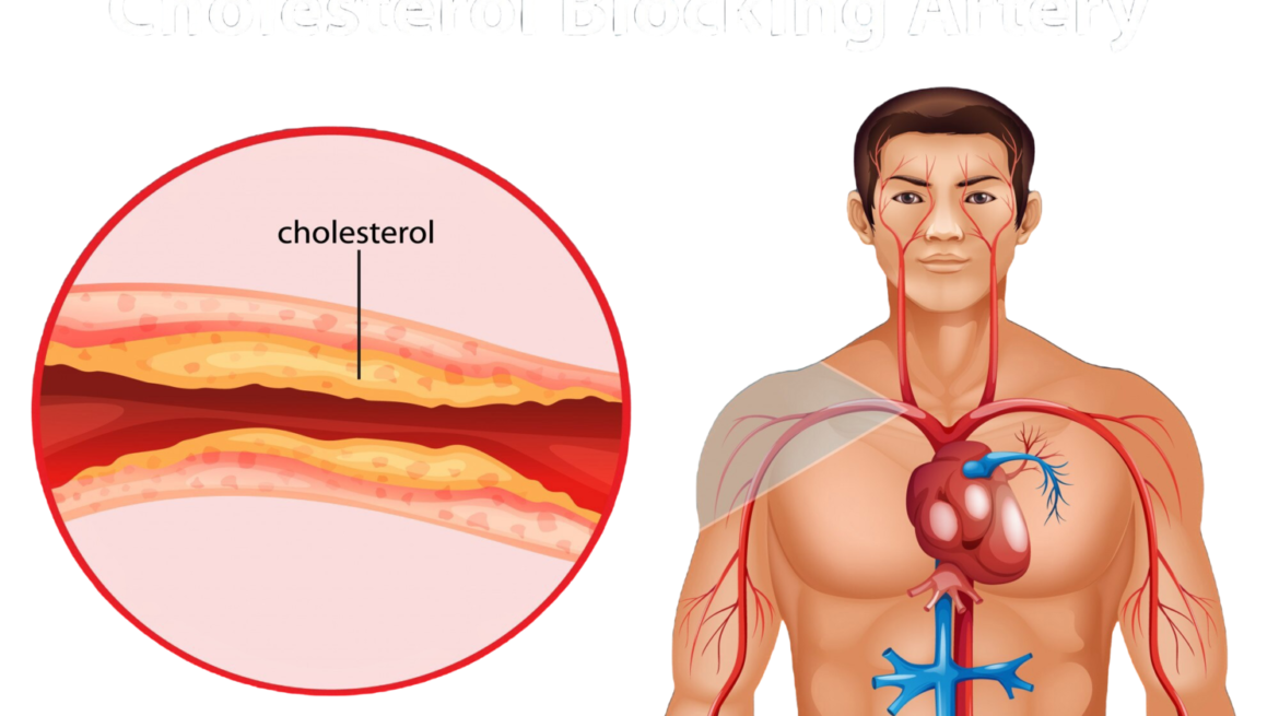 kolesterol jahat (1)