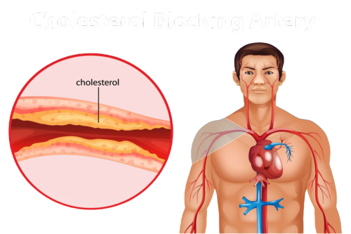 kolesterol jahat (1)